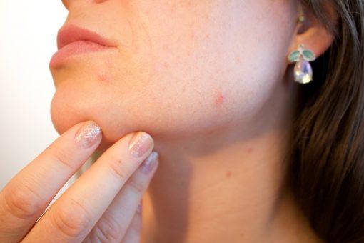 Know Your Acne: Different Types of Acne (and what to do about them)